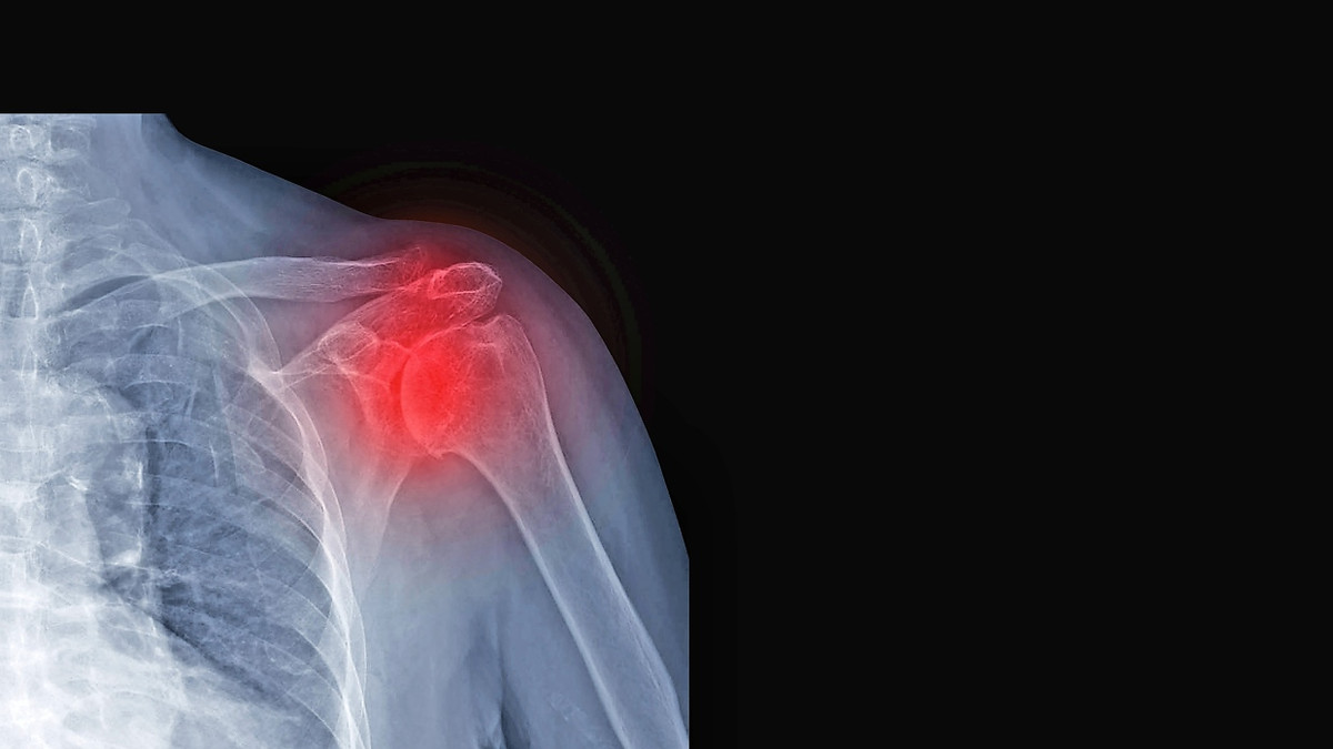 Chronische Schmerzen: Rheuma ist keine Frage des Alters